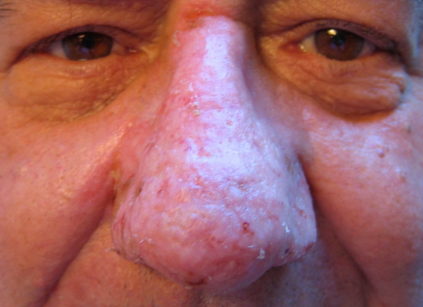 Picture of normal nose contour following dermabrasion to treat bulbous Rosacea