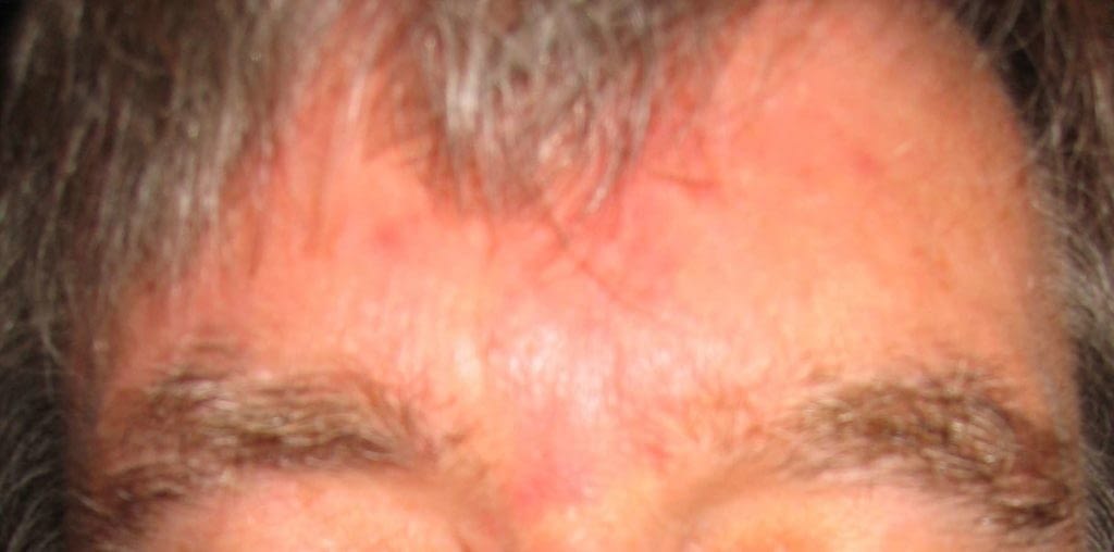 Picture of glabella with Rosacea & ruptured vessels post vascular laser treatment