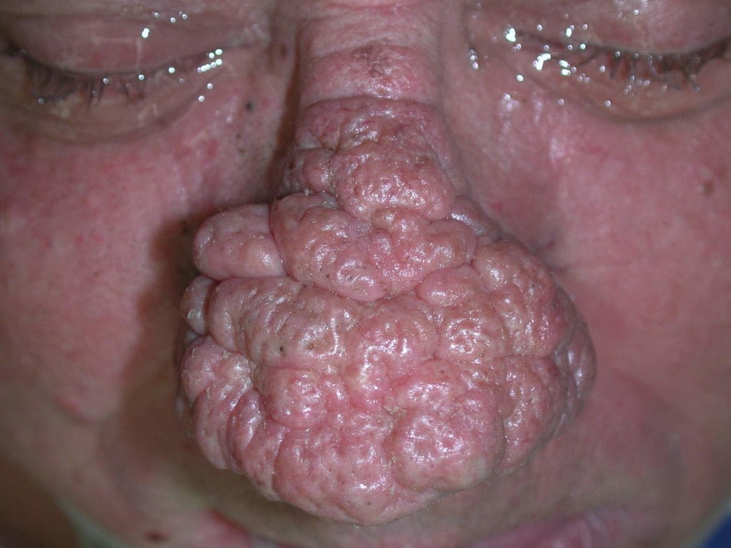 Pre Op picture of Bulbous Rosacea Nasal Deformity