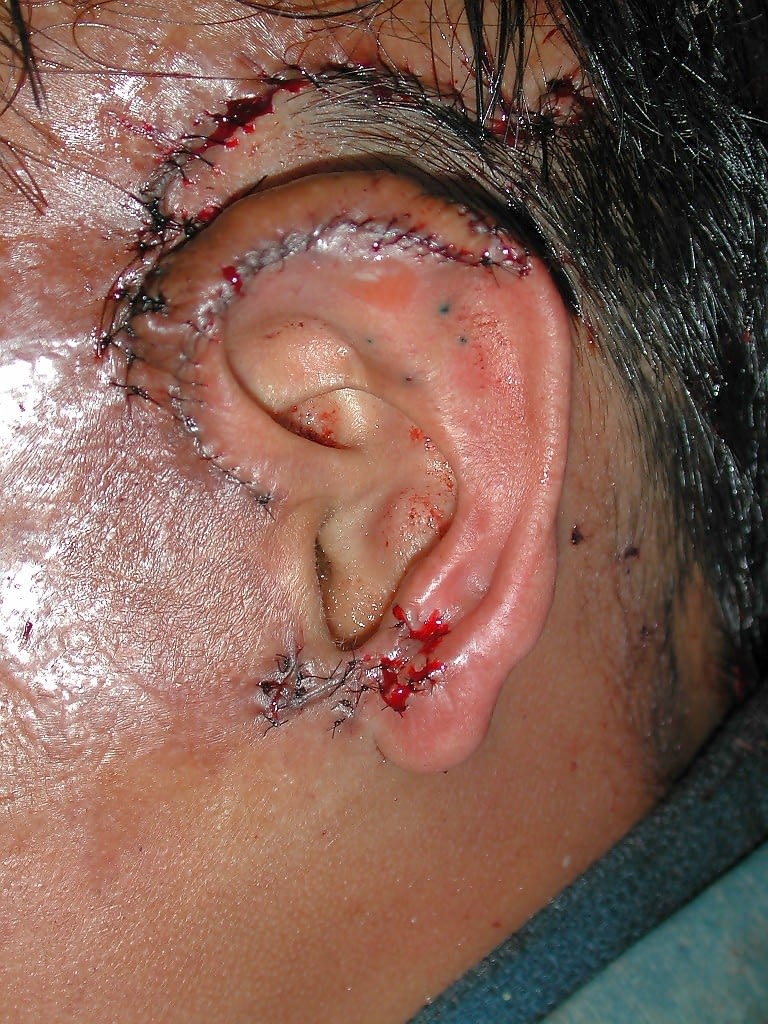 Picture of an ear which was burned off