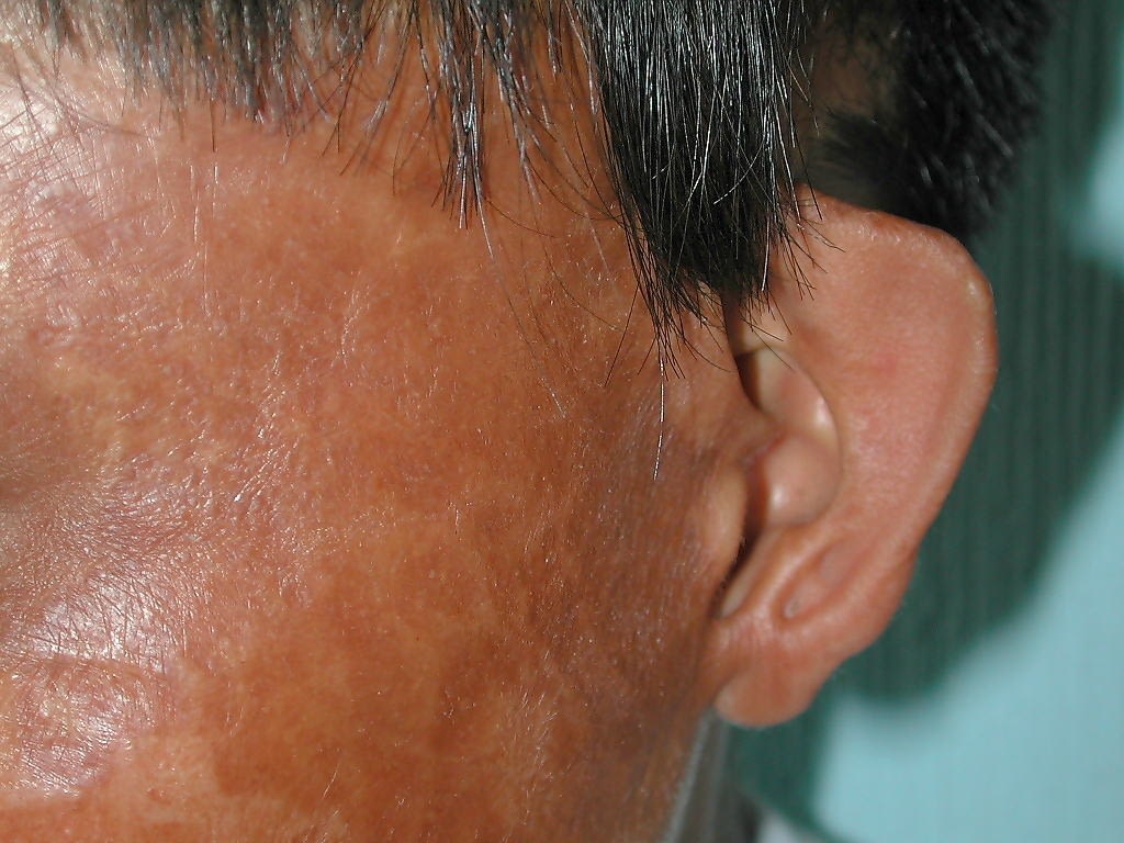 Preoperative Picture of the burn defect causing child's ear to lose the upper 1/3 of the pinna and scars deforming the normal ear shape