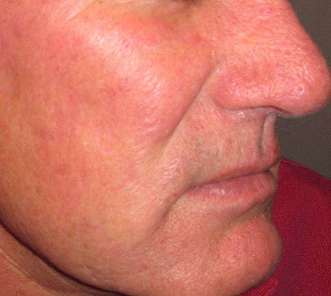 Picture of glabella with Rosacea & ruptured vessels post vascular laser treatment