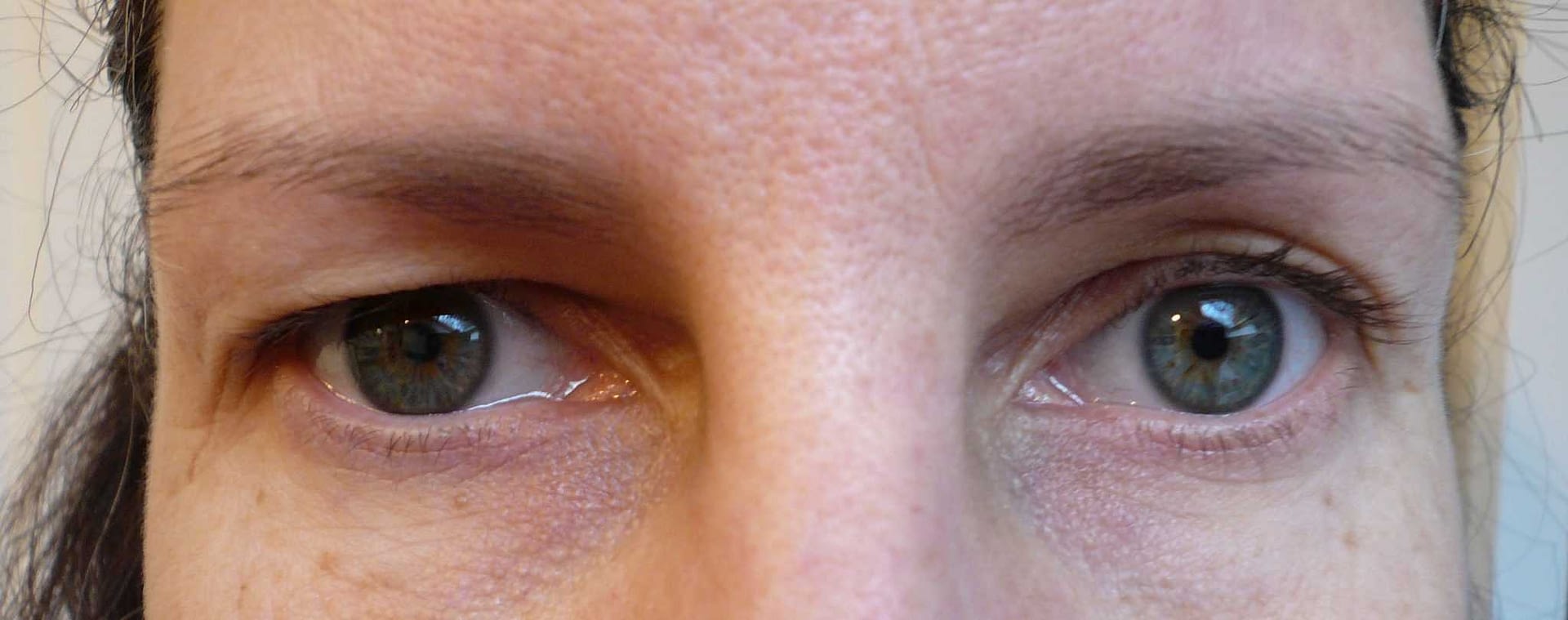 prepay-blepharoplasty-upper-eyelids-upper-eyelid-skin-removal