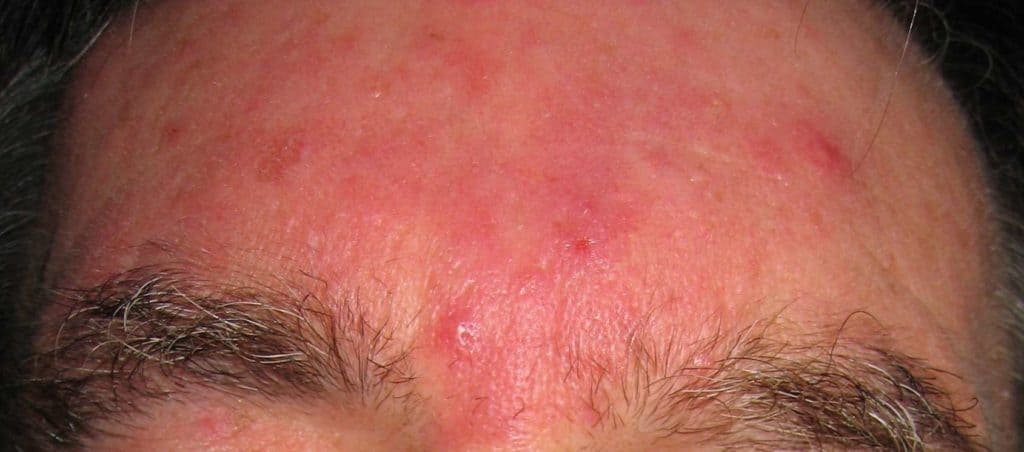 Picture of glabella with Rosacea & ruptured vessels prior to vascular laser treatment