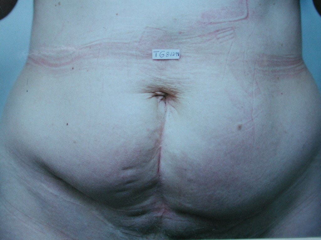 image of preop abdomioplasty tummy tuck mommy make over surgery by Dr. O'Sullivan 