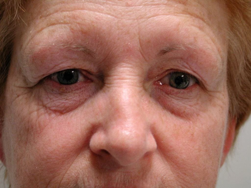 Image of Eyelid Tightening Blepharoplasty Preop by Rhode Island  Plastic Surgery excellence