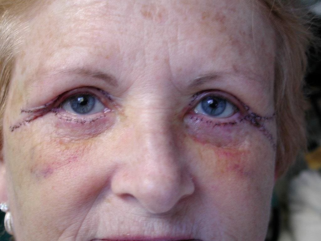 Image of post op Blepharoplasty Eyelid tightening with perfect results and non-visible scar by Best R.I. Plastic Surgeon