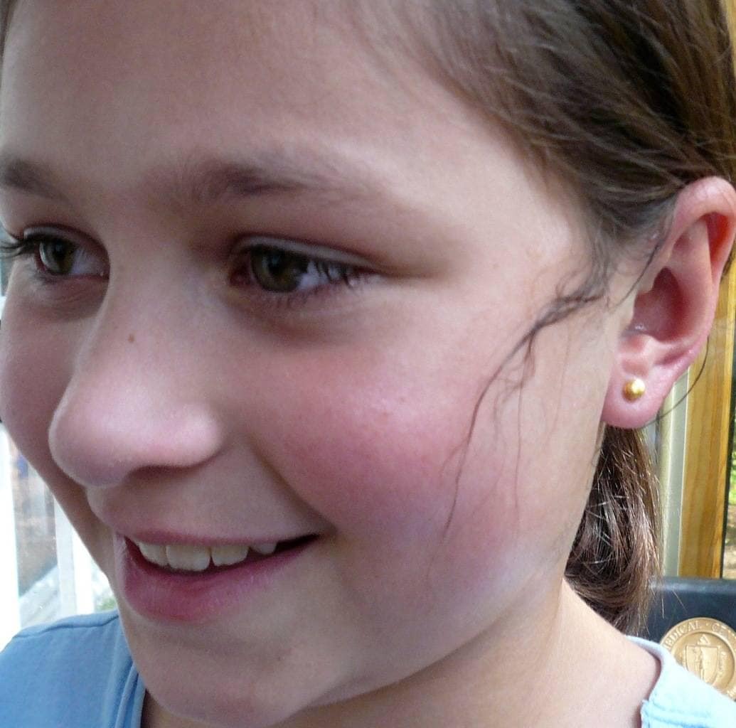 Ear Piercing by Rhode Island Board Certified Plastic Surgeon