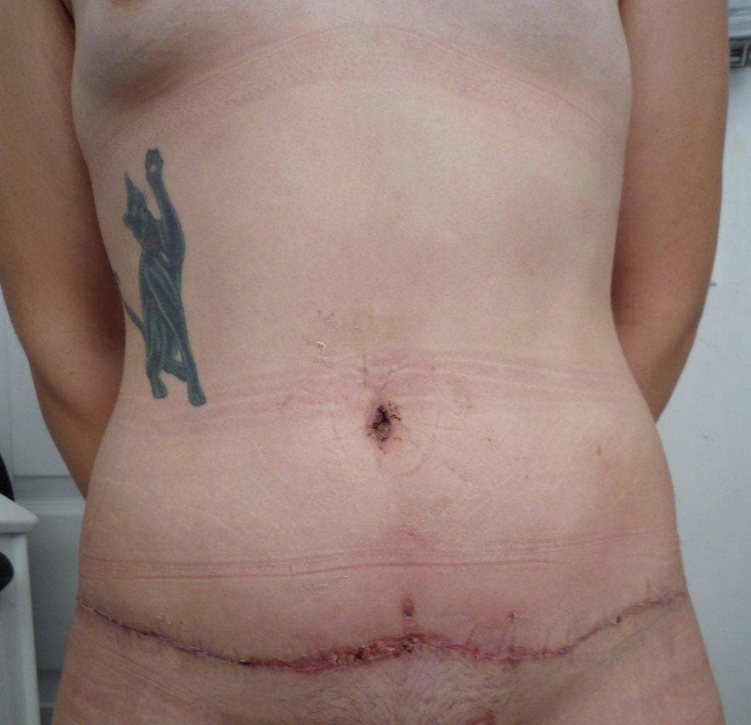 image of amazing best contour post abdominoplasty tummy tuck mommy make over surgery 