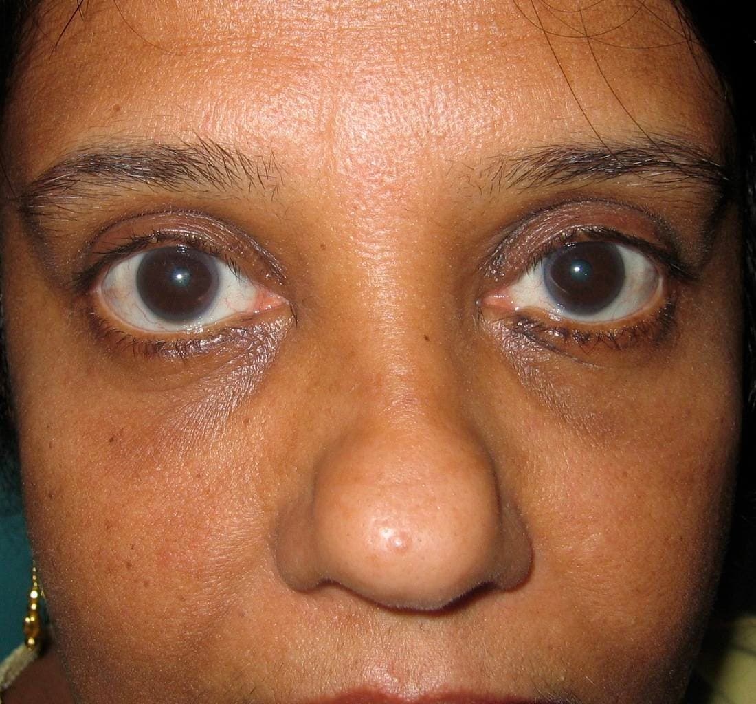 Image of post op Blepharoplasty Eyelid tightening with perfect results and non-visible scar by Best R.I. Plastic Surgeon