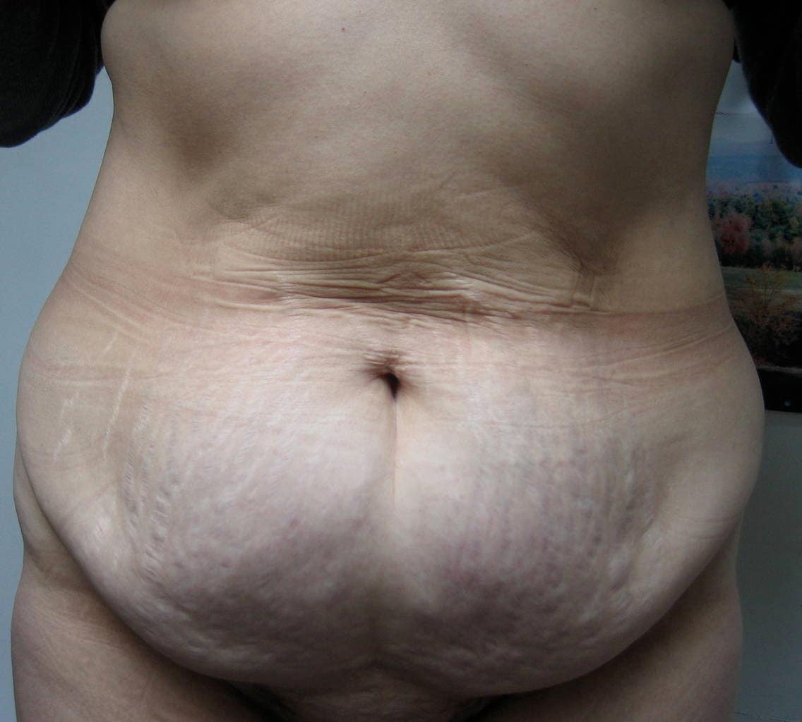 image of preop abdomioplasty tummy tuck mommy make over surgery by Dr. O'Sullivan 