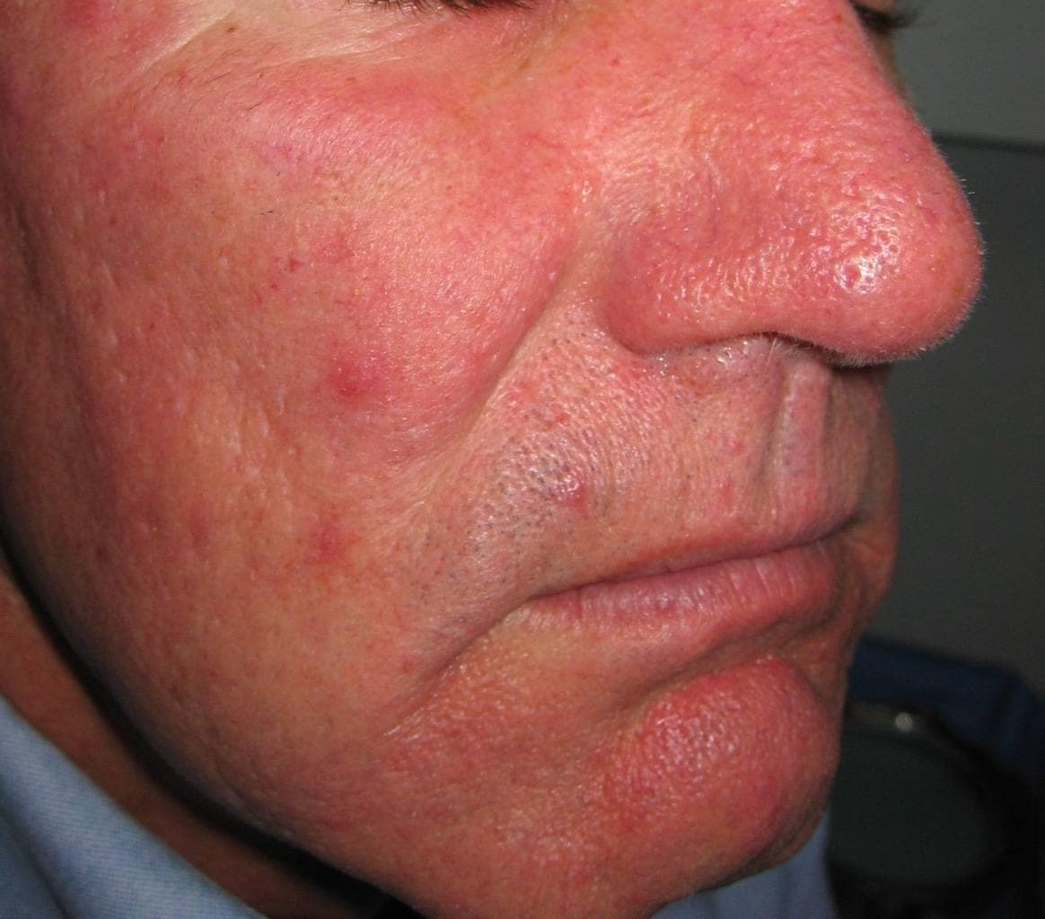Picture of glabella with Rosacea & ruptured vessels prior to vascular laser treatment
