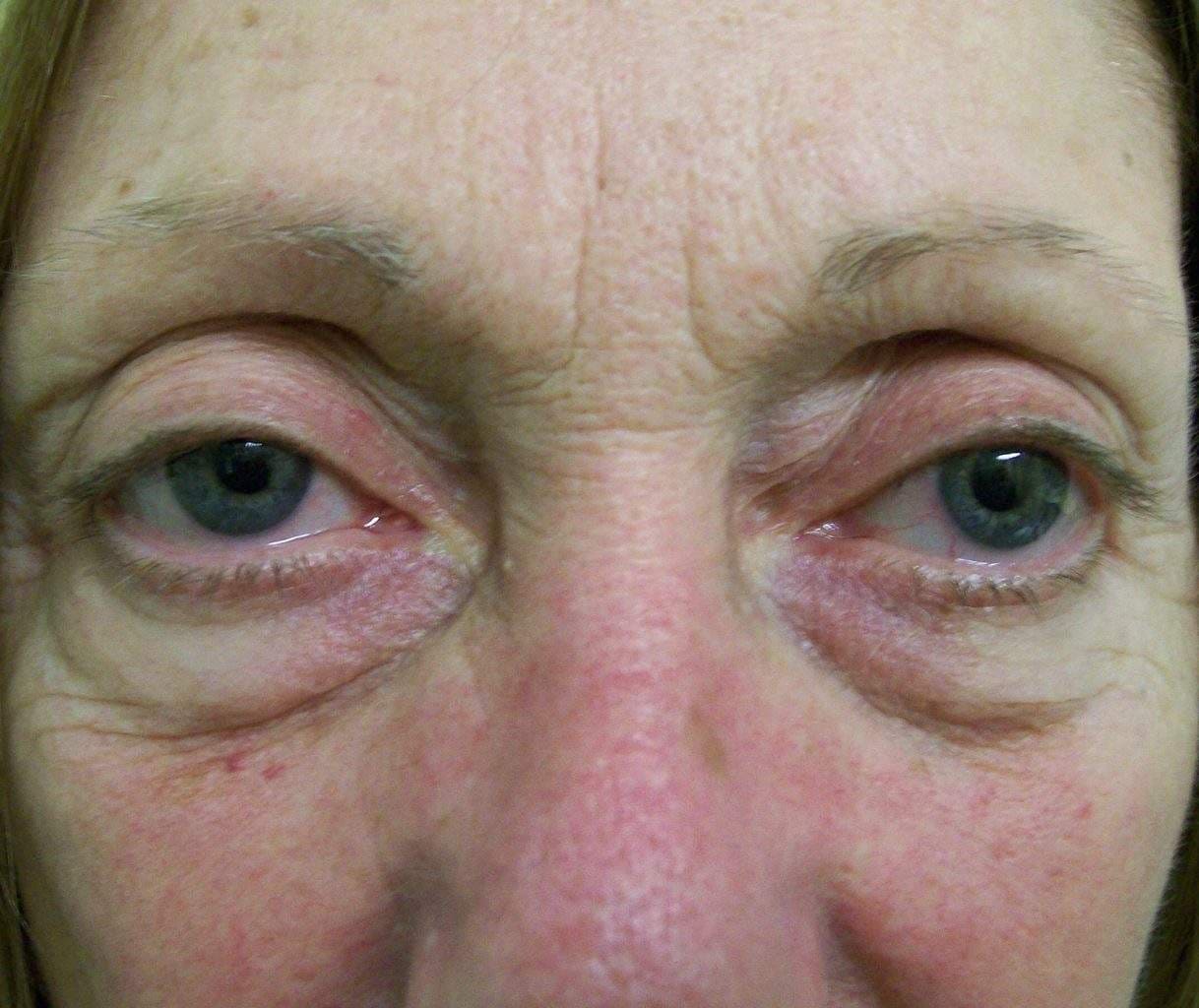 Image of Eyelid Tightening Blepharoplasty Preop by Rhode Island  Plastic Surgery excellence