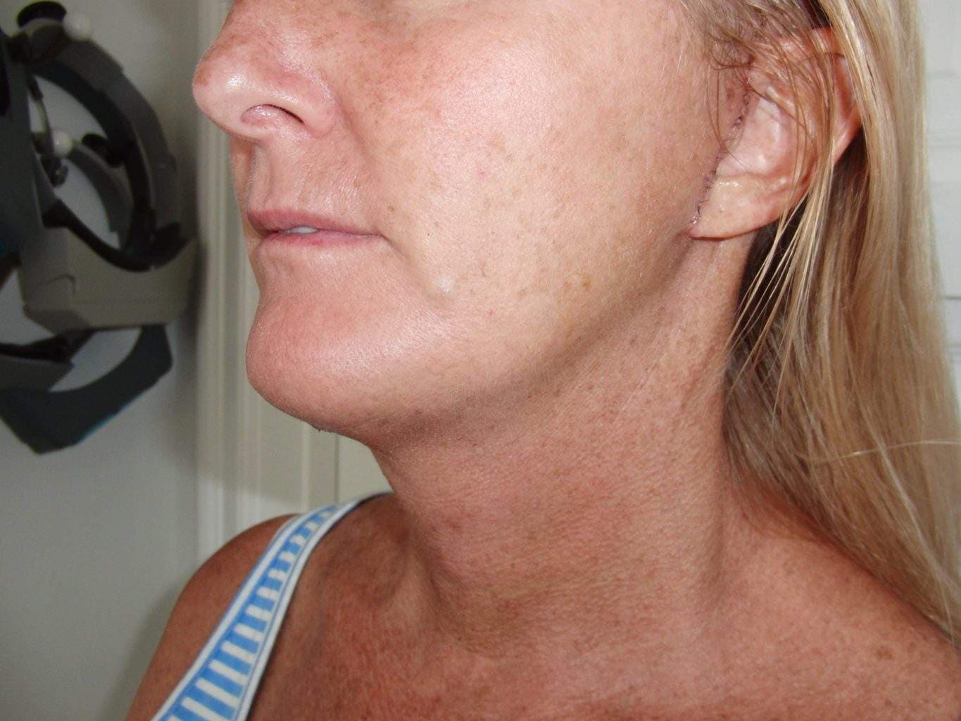 Post Op image of excellent Smartlipo Neck Liposuction