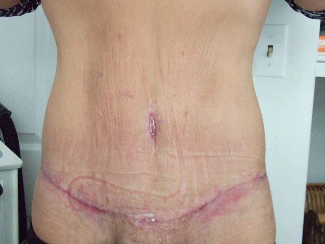 image of amazing best contour post abdominoplasty tummy tuck mommy make over surgery 