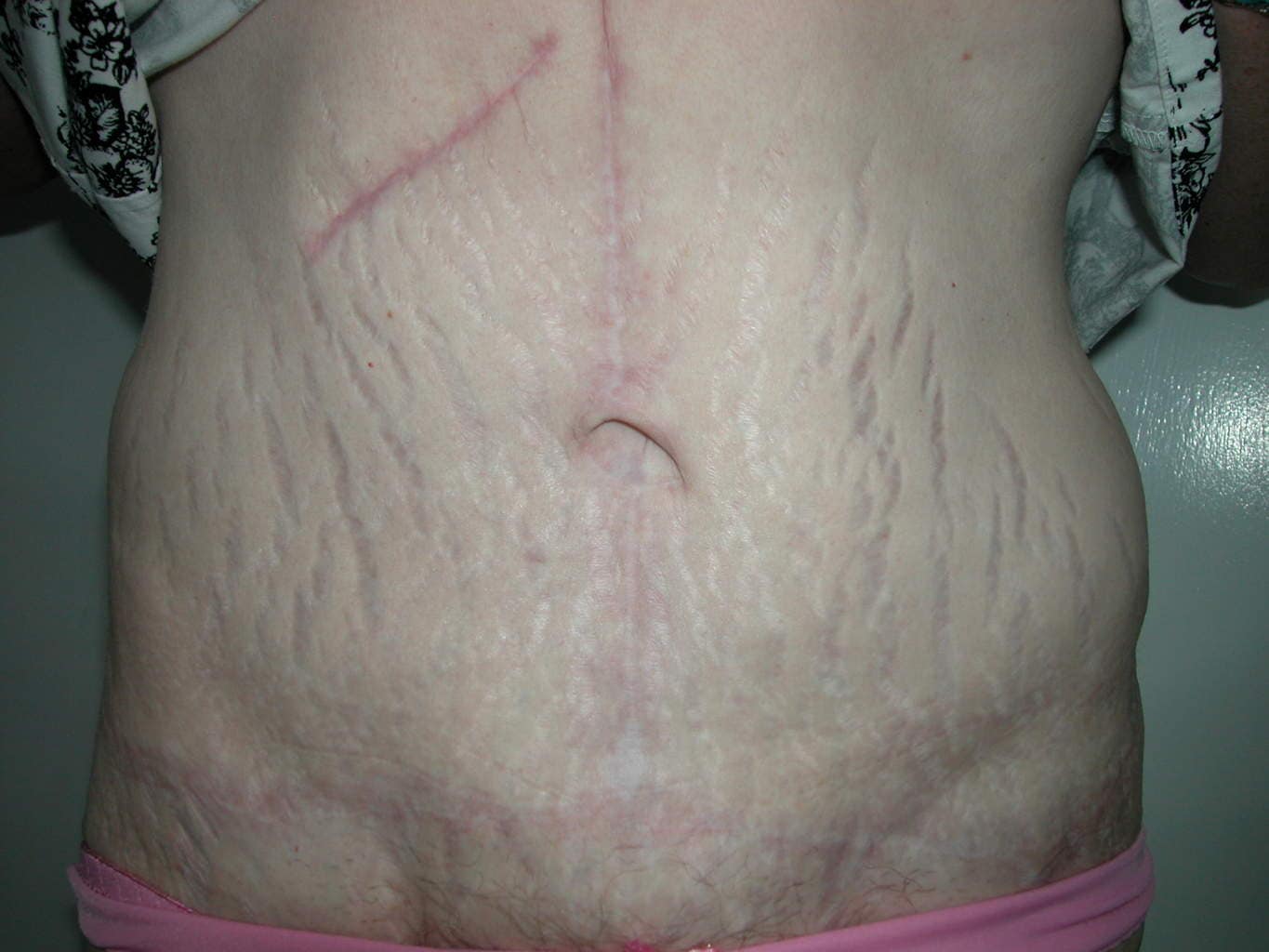 image of amazing best contour post abdominoplasty tummy tuck mommy make over surgery 