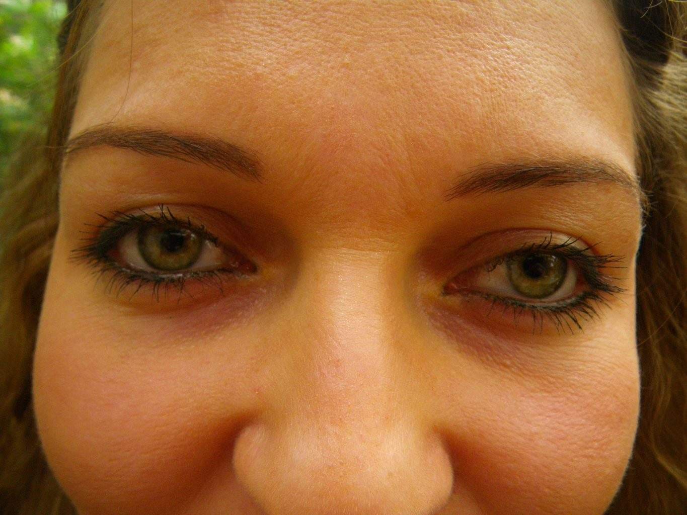 Image of Eyelid Tightening Blepharoplasty Preop by Rhode Island  Plastic Surgery excellence