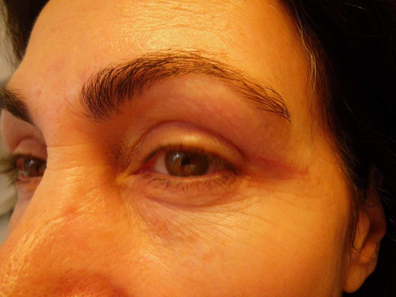 Image of post op Blepharoplasty Eyelid tightening with perfect results and non-visible scar by Best R.I. Plastic Surgeon