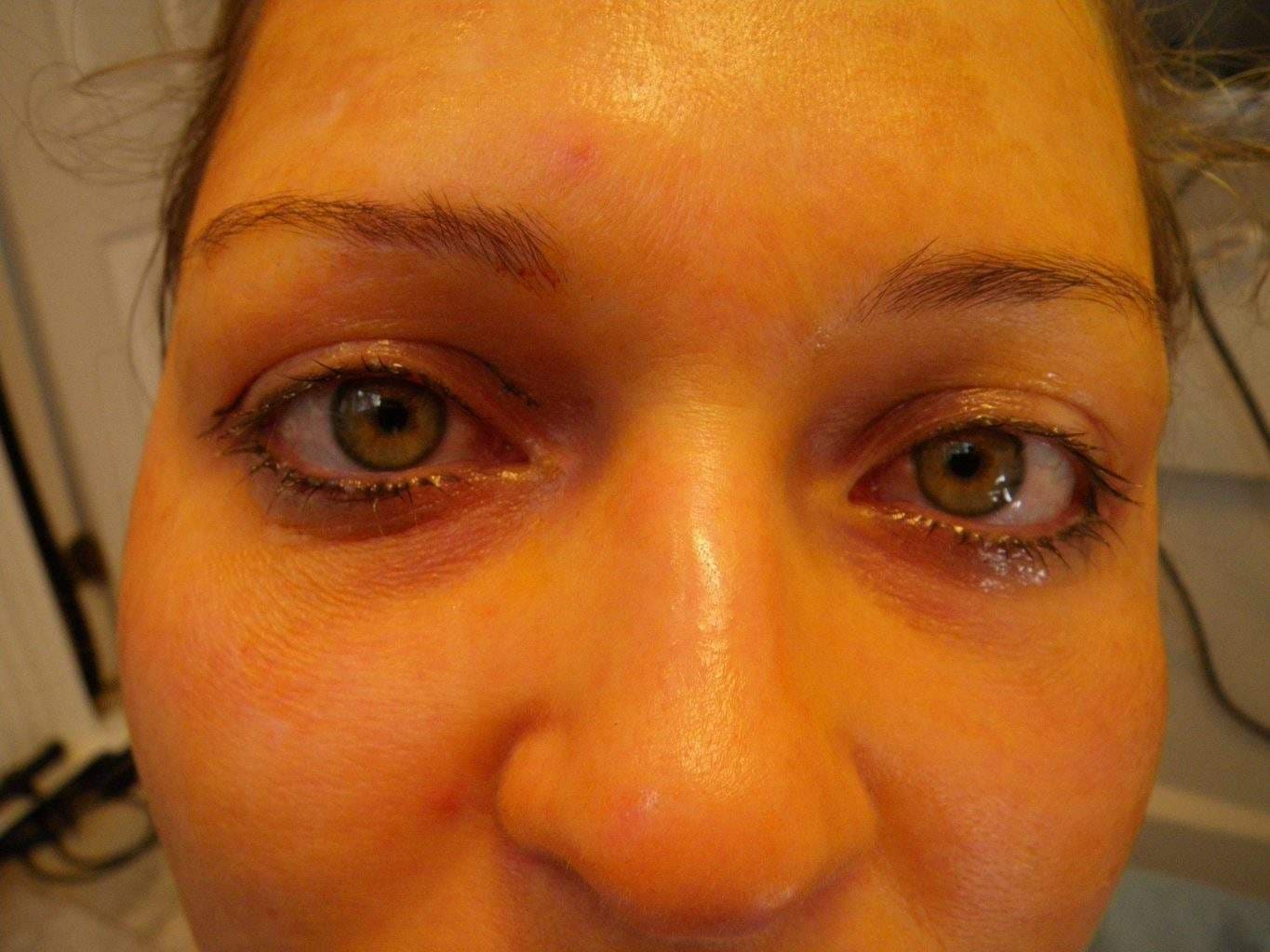 Image of post op Blepharoplasty Eyelid tightening with perfect results and non-visible scar by Best R.I. Plastic Surgeon