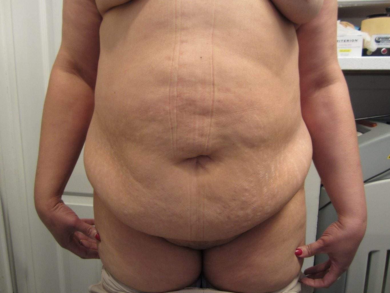 image of preop abdomioplasty tummy tuck mommy make over surgery by Dr. O'Sullivan 