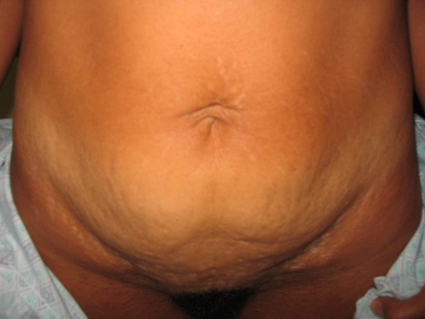 image of preop mini abdomioplasty tummy tuck mommy make over surgery by Dr. O'Sullivan 