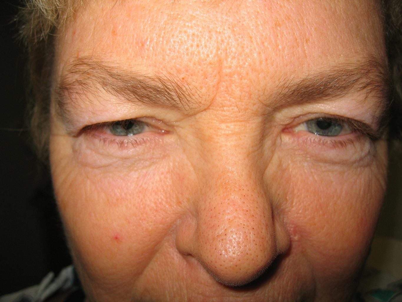 Image of Eyelid Tightening Blepharoplasty Preop by Rhode Island  Plastic Surgery excellence