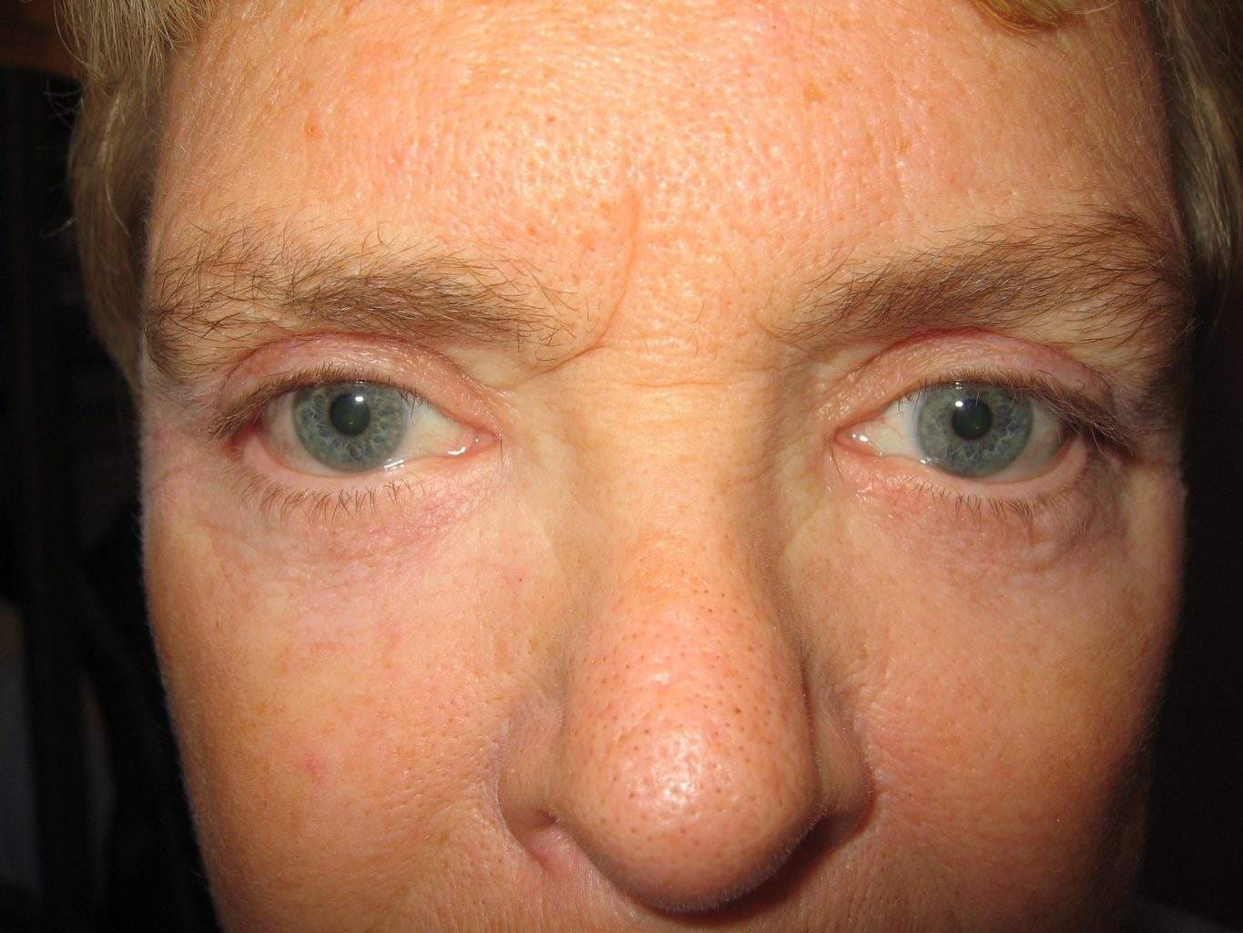 Image of post op Blepharoplasty Eyelid tightening with perfect results and non-visible scar by Best R.I. Plastic Surgeon
