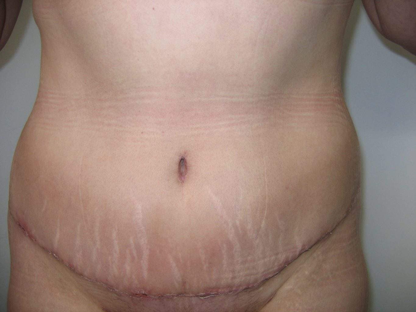 image of amazing best contour post abdominoplasty tummy tuck mommy make over surgery 