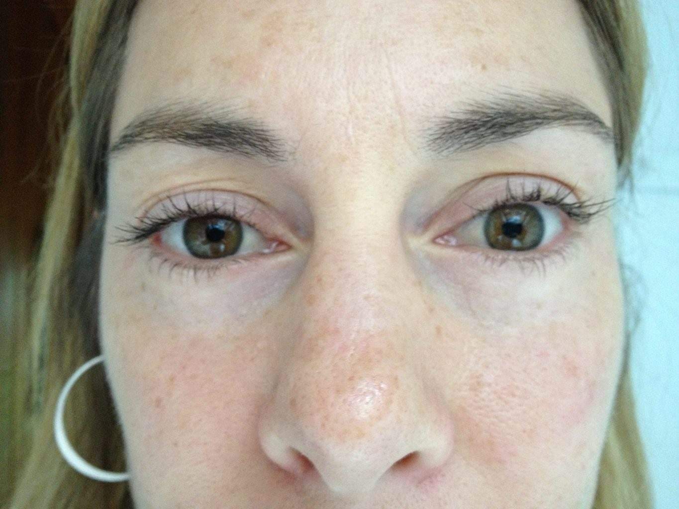 Image of post op Blepharoplasty Eyelid tightening with perfect results and non-visible scar by Best R.I. Plastic Surgeon