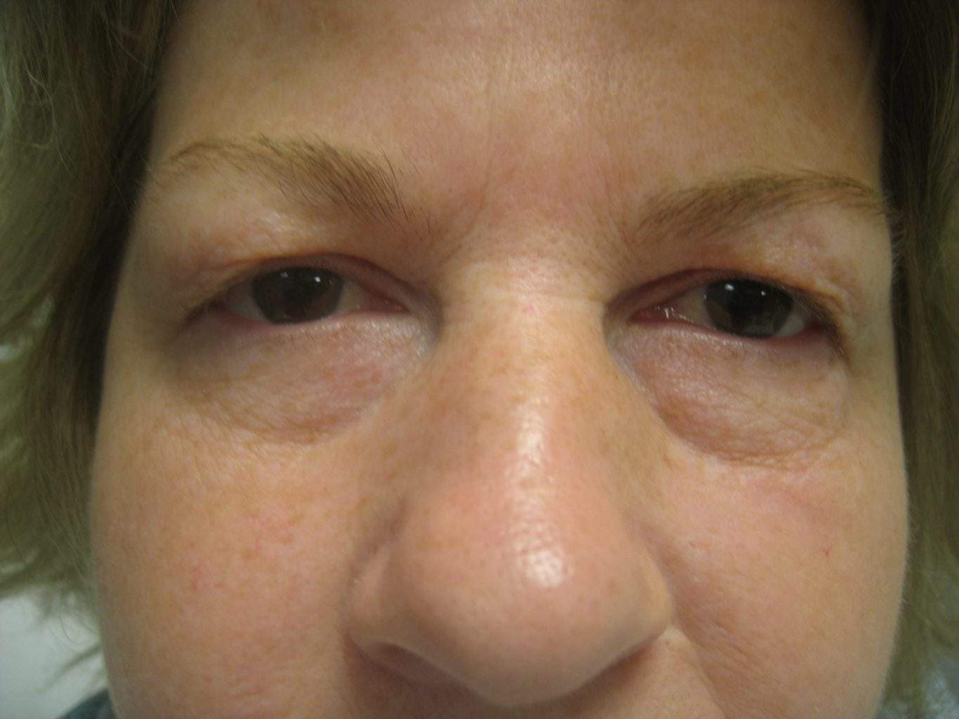 Image of Eyelid Tightening Blepharoplasty Preop by Rhode Island  Plastic Surgery excellence