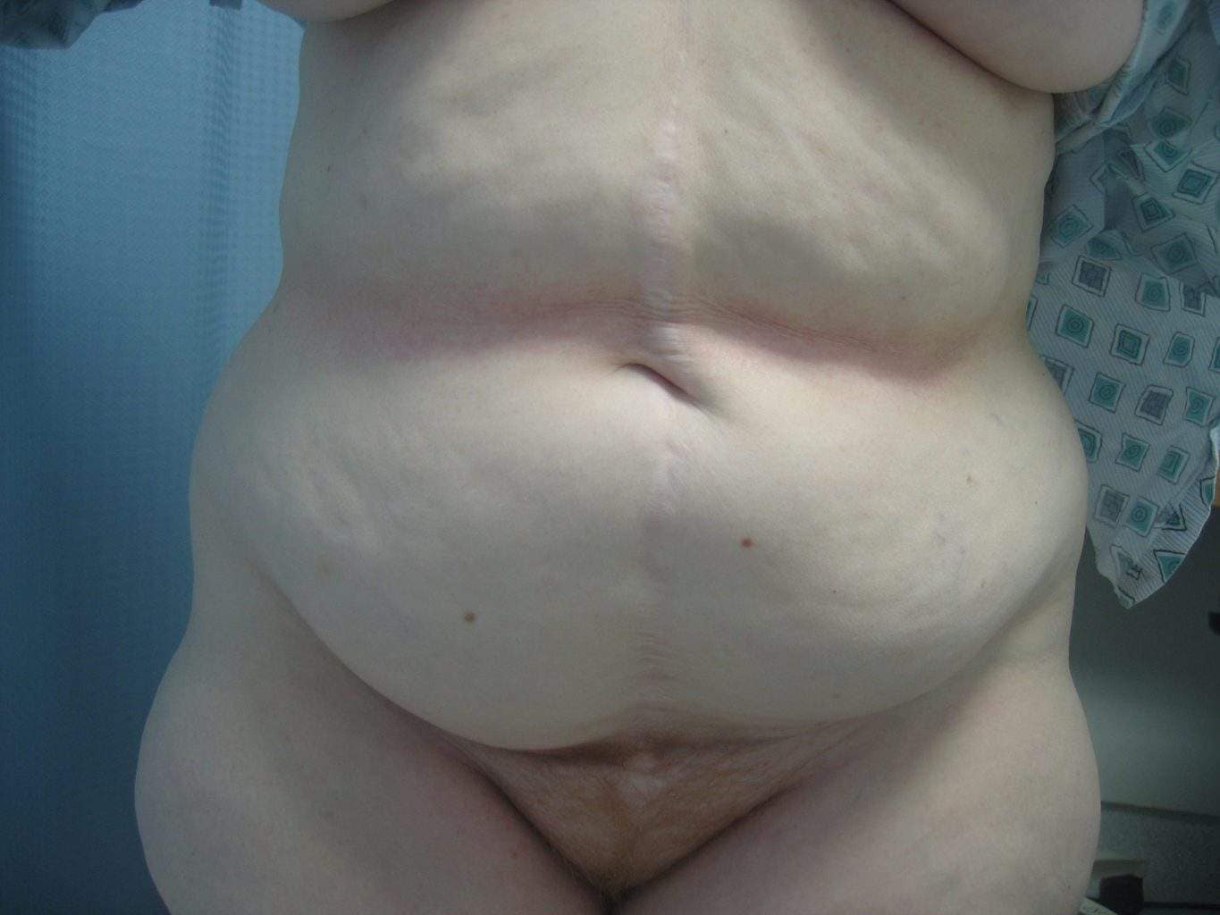 image of preop abdomioplasty tummy tuck mommy make over surgery by Dr. O'Sullivan 