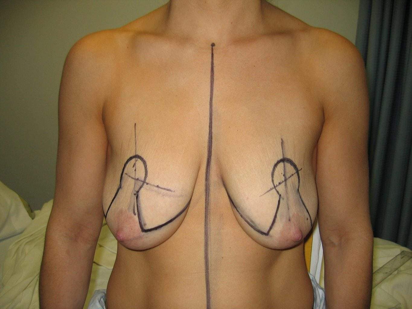image of deflated ptotic breast with markings for breast Lift Mastopexy + Implant Rhode Island Female Plastic Surgeon Preop