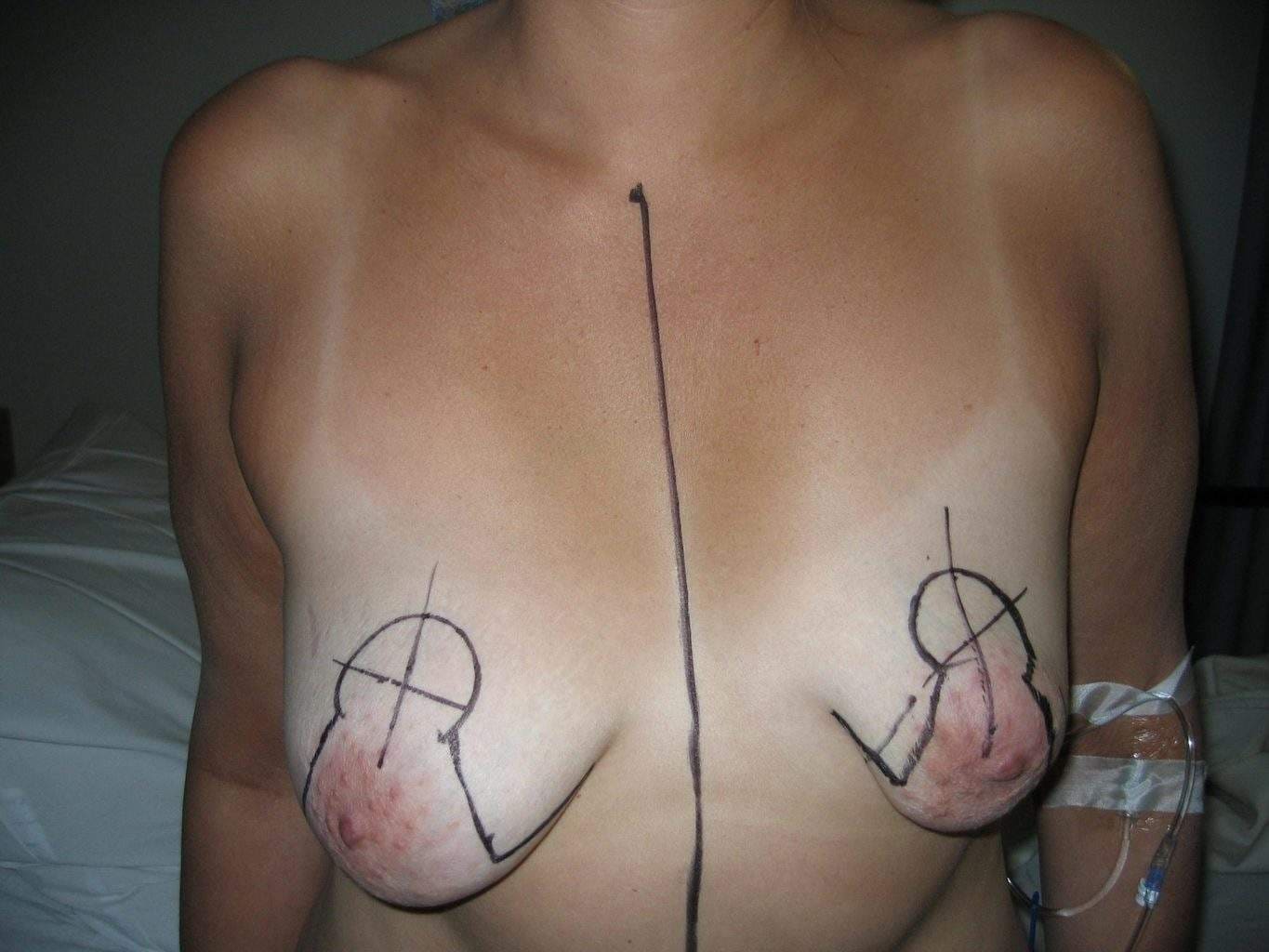 Image of asymmetric tubular breast scheduled for cosmetic Breast Lift Mastopexy + Implant Rhode Island Female Plastic Surgeon Preop