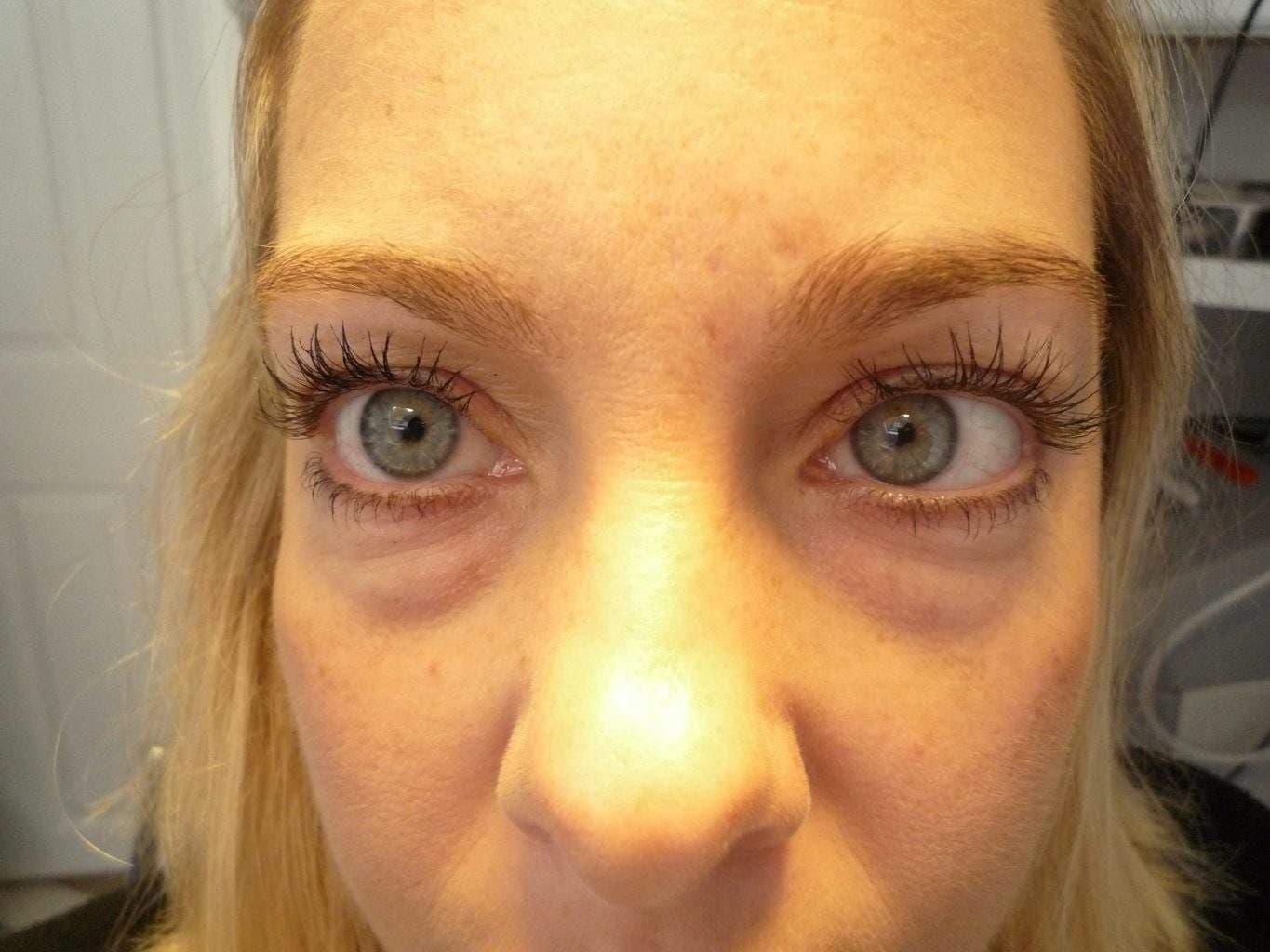 Image of Eyelid Tightening Blepharoplasty Preop by Rhode Island  Plastic Surgery excellence