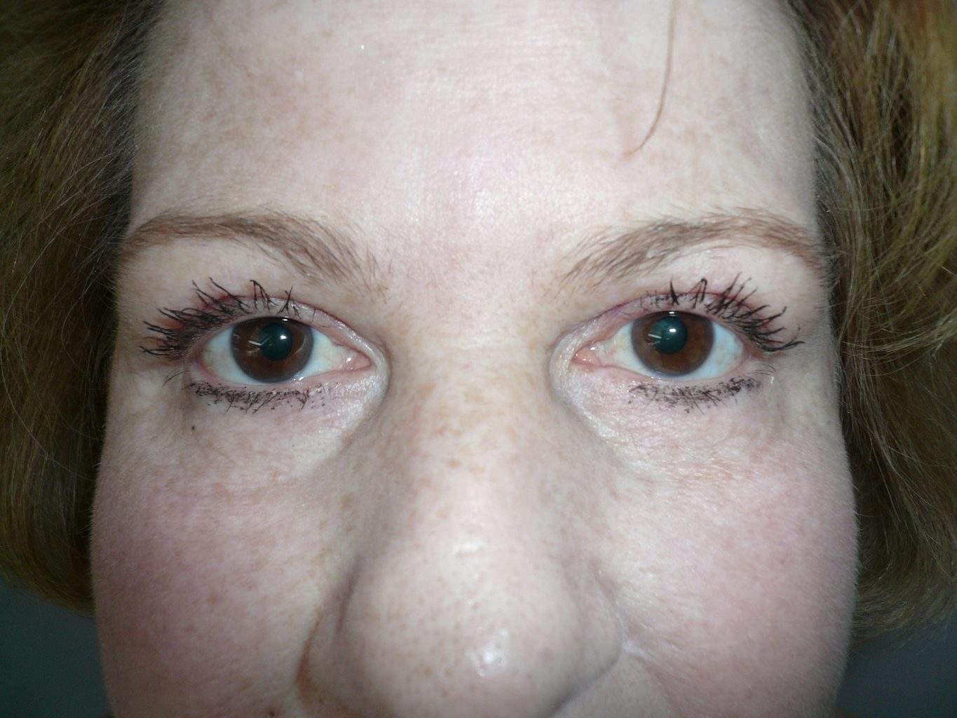 Image of post op Blepharoplasty Eyelid tightening with perfect results and non-visible scar by Best R.I. Plastic Surgeon