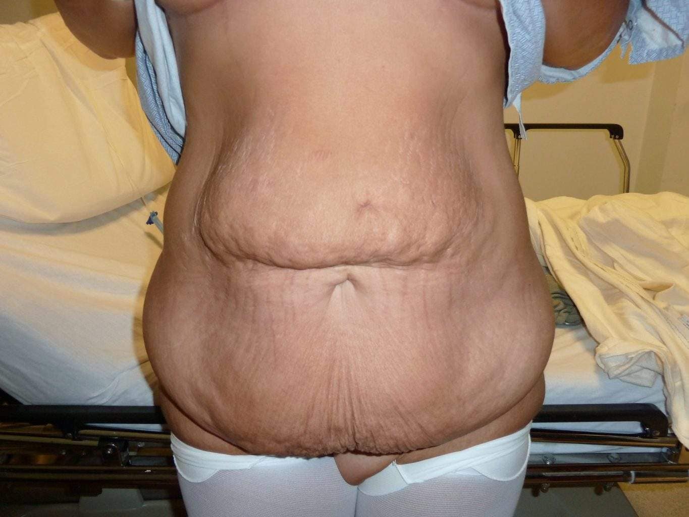image of preop abdomioplasty tummy tuck mommy make over surgery by Dr. O'Sullivan 