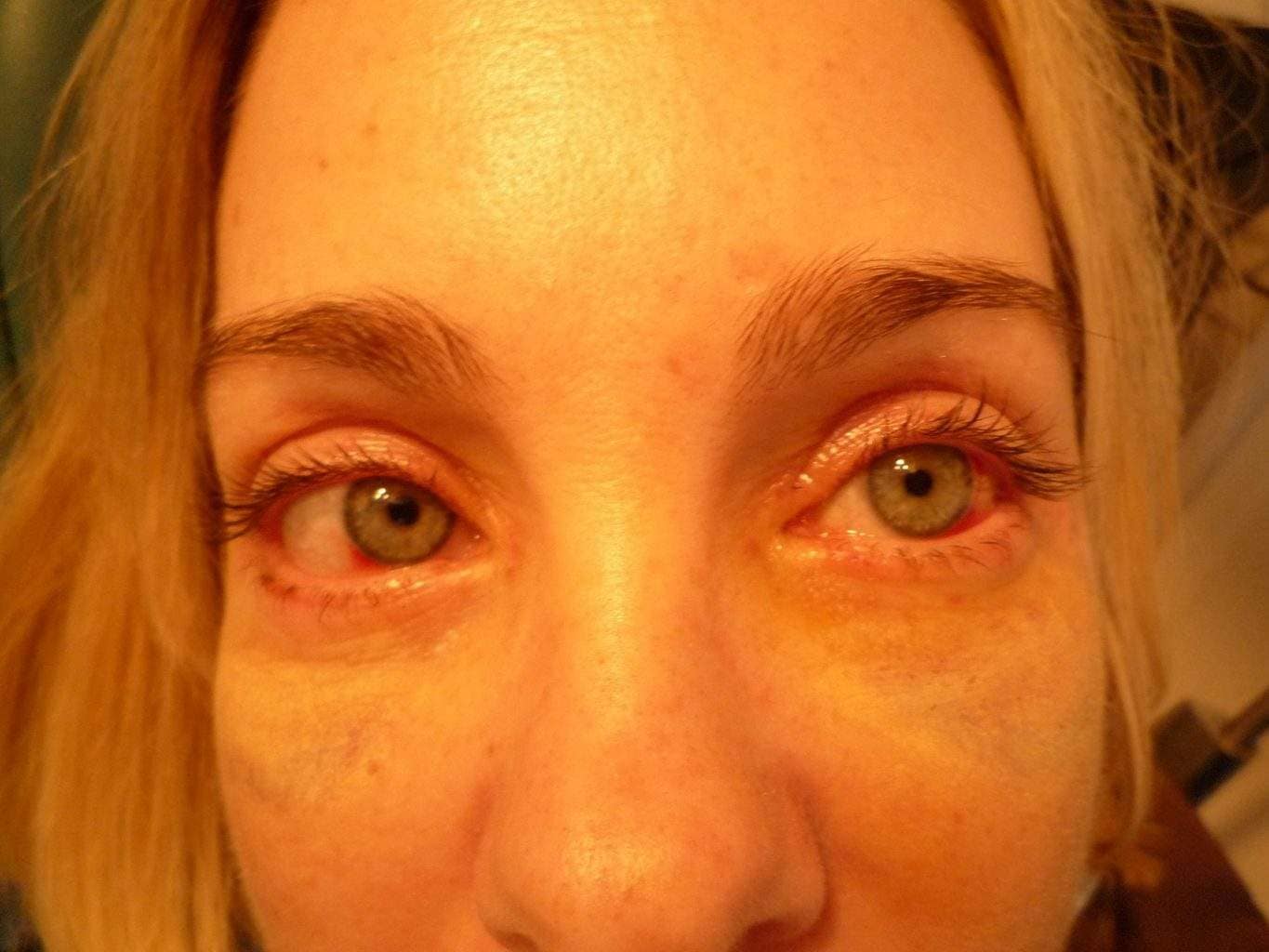 Image of post op Blepharoplasty Eyelid tightening with perfect results and non-visible scar by Best R.I. Plastic Surgeon