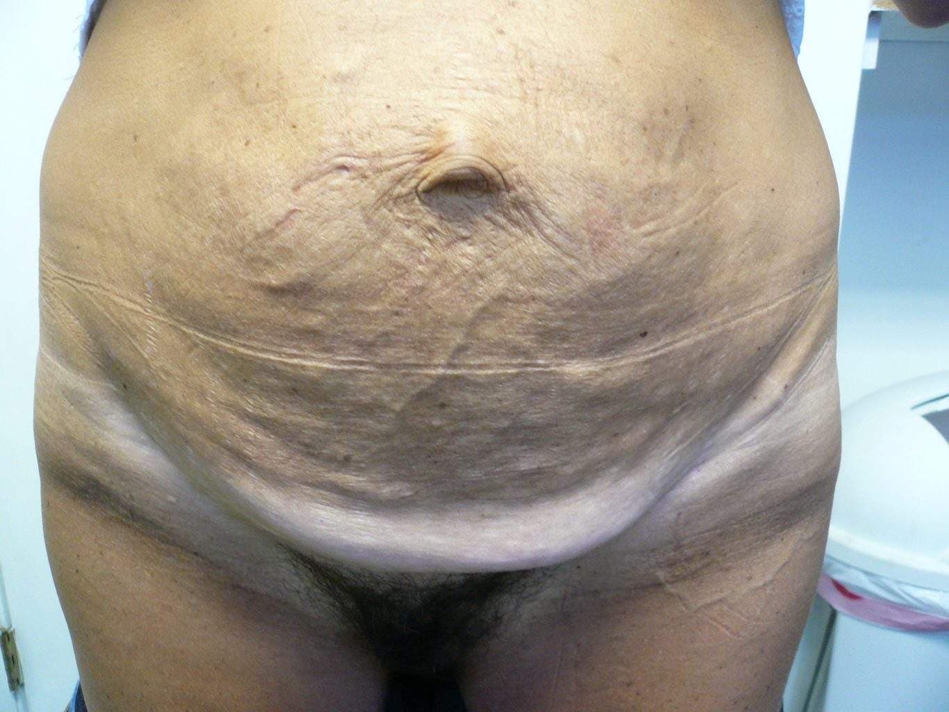 image of preop abdomioplasty tummy tuck mommy make over surgery by Dr. O'Sullivan 