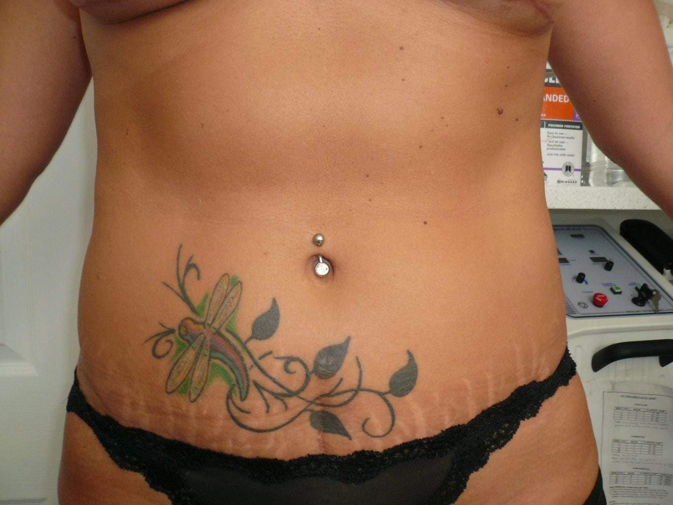 image of amazing best contour post abdominoplasty tummy tuck mommy make over surgery 