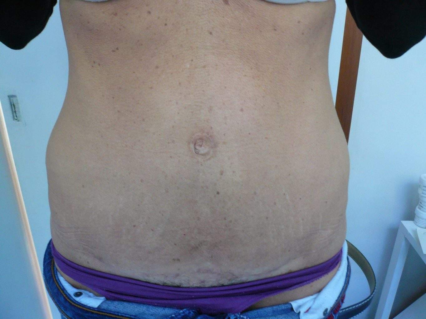 image of amazing best contour post abdominoplasty tummy tuck mommy make over surgery 