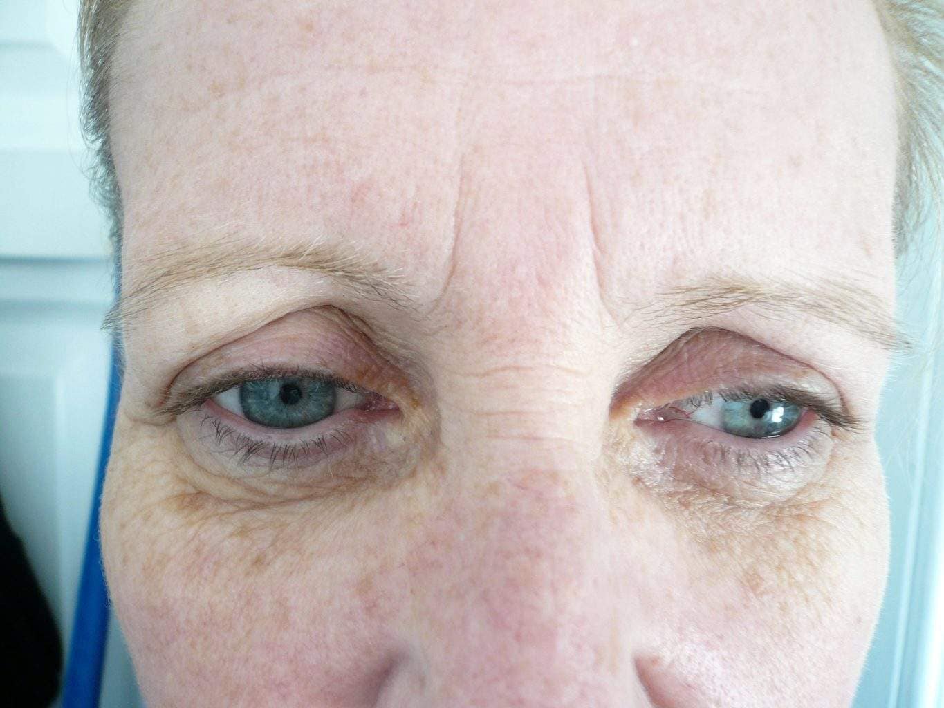 Image of Eyelid Tightening Blepharoplasty Preop by Rhode Island  Plastic Surgery excellence