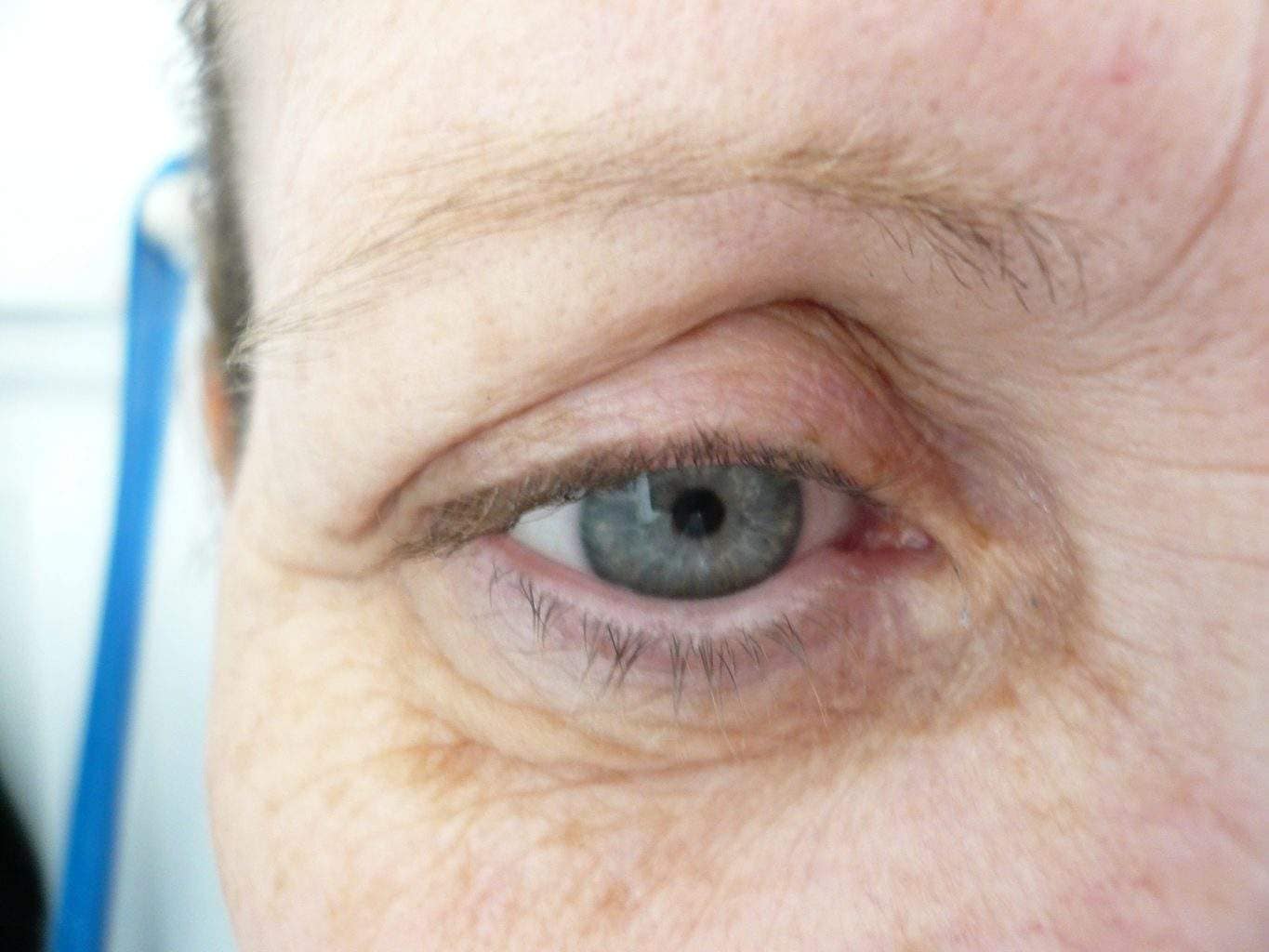 Image of Eyelid Tightening Blepharoplasty Preop by Rhode Island  Plastic Surgery excellence