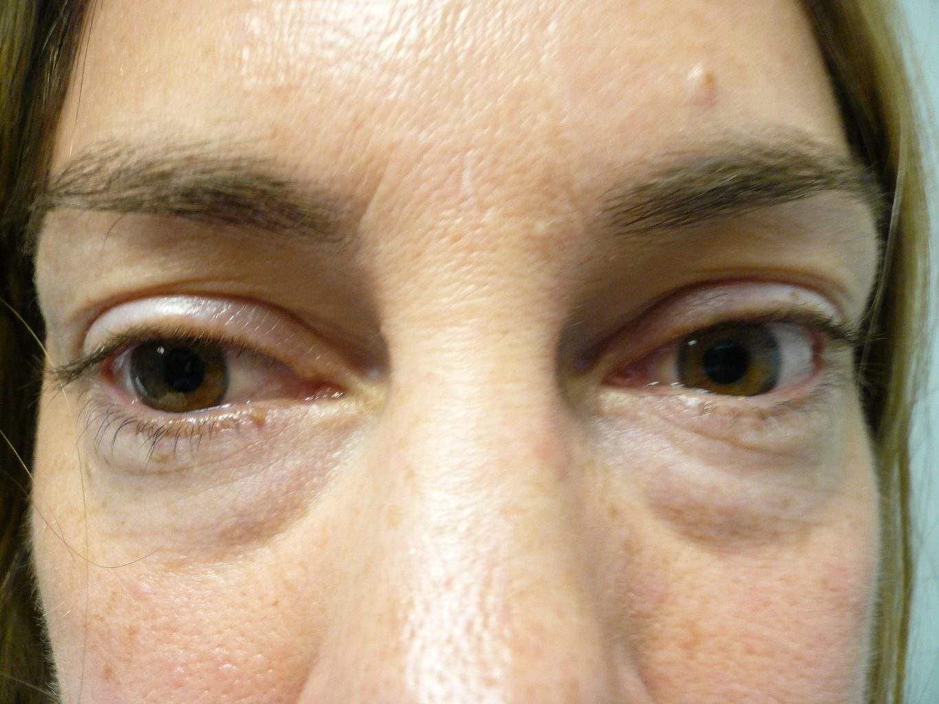 Image of Eyelid Tightening Blepharoplasty Preop by Rhode Island  Plastic Surgery excellence
