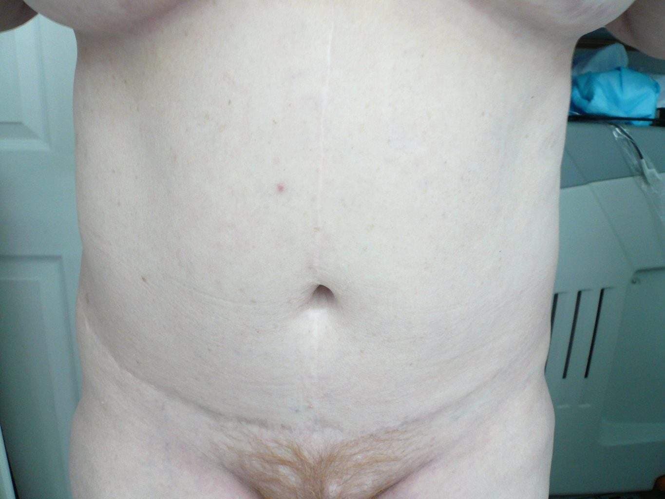 image of amazing best contour post abdominoplasty tummy tuck mommy make over surgery 
