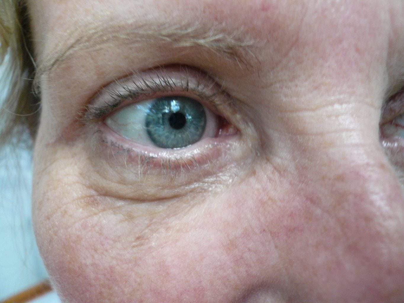 Image of post op Blepharoplasty Eyelid tightening with perfect results and non-visible scar by Best R.I. Plastic Surgeon