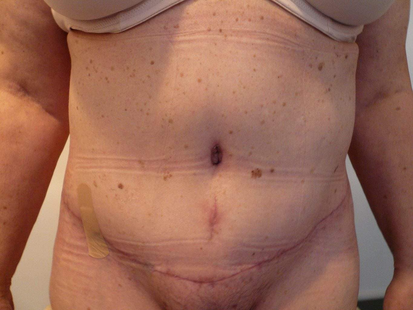 image of amazing best contour post abdominoplasty tummy tuck mommy make over surgery 