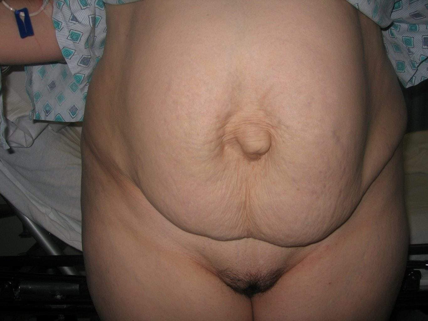 image of preop abdomioplasty tummy tuck mommy make over surgery by Dr. O'Sullivan 