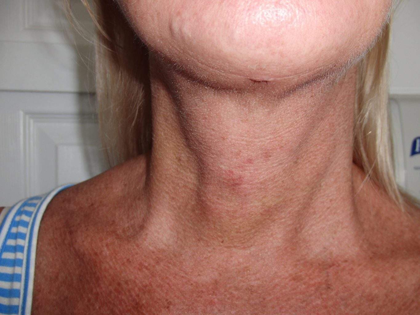 Post Op image of excellent Smartlipo Neck Liposuction