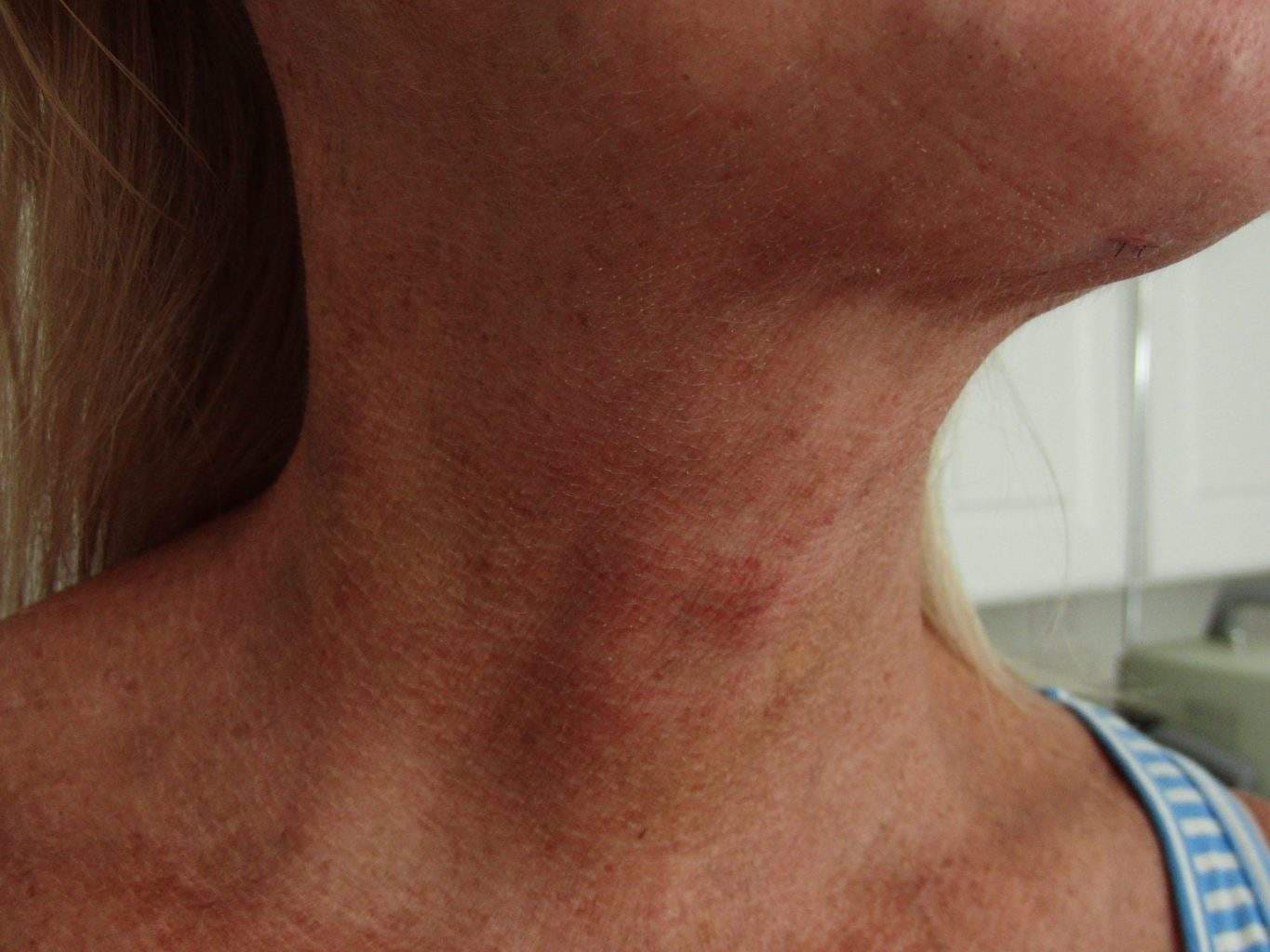 Post Op image of excellent Smartlipo Neck Liposuction