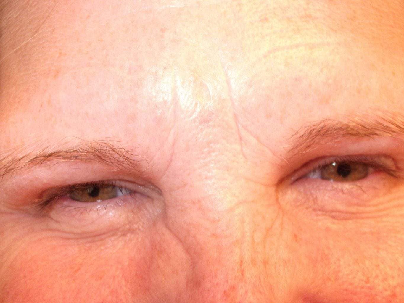 Image of post treatment forehead treated with Dysport or Botox Paralytic with excellent result